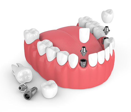 Dental Implants Danville VA